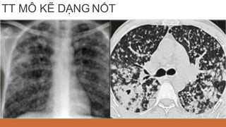 TT MÔ KẼ DẠNG NỐT
 