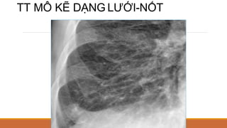 TT MÔ KẼ DẠNG LƯỚI-NỐT
 