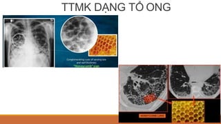 TTMK DẠNG TỔ ONG
 