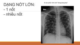 DẠNG NỐT LỚN:
- 1 nốt
- nhiều nốt
Di căn phổi: hình ảnh “bong bóng bay”
 