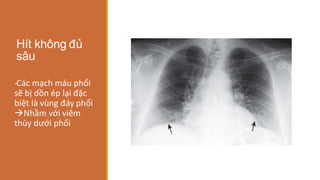 Hít không đủ
sâu
-
‐Các mạch máu phổi
sẽ bị dồn ép lại đặc
biệt là vùng đáy phổi
Nhầm với viêm
thùy dưới phổi
 