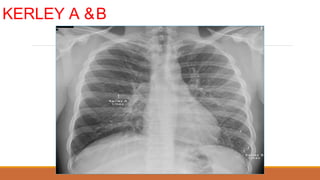 KERLEY A &B
 