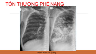TỔN THƯƠNG PHẾ NANG
Bn hít thuốc cản quang
 