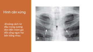 Hình cân xứng
-
‐Khoảng cách từ
đầu trong xương
đòn đến mỏm gai
đốt sống ngực hai
bên bằng nhau
 
