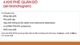 Có thể gặp trong:
◦ Đông đặc phổi
◦ Phù phổi cấp
◦ Xẹp phổi không do tắc nghẽn (non-obstructive atelectasis)
◦ U (UTBM TPQ-PN, lymphoma)
◦ Nhồi máu phổi
Hình ảnh KPQ đồ tồn tại trong nhiều tuần dù điều trị kháng sinh thích hợp nghingờ u phổi kếthợp
CT và sinh thiết
4.KHÍ PHẾ QUẢN ĐỒ
(air-bronchogram)
 