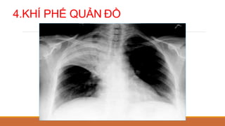 4.KHÍ PHẾ QUẢN ĐỒ
 