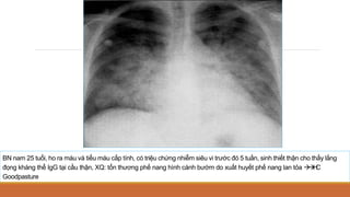 BN nam 25 tuổi, ho ra máu và tiểu máu cấp tính, có triệu chứng nhiễm siêu vi trước đó 5 tuần, sinh thiết thận cho thấy lắng
đọng kháng thể IgG tại cầu thận, XQ: tổn thương phế nang hình cánh bướm do xuất huyết phế nang lan tỏa 

H
C
Goodpasture
 