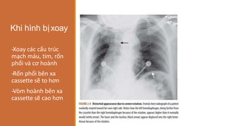 Khi hình bịxoay
-
‐Xoay các cấu trúc
mạch máu, tim, rốn
phổi và cơ hoành
-
‐Rốn phổi bên xa
cassette sẽ to hơn
-
‐Vòm hoành bên xa
cassette sẽ cao hơn
 