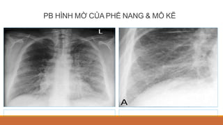 PB HÌNH MỜ CỦA PHẾ NANG & MÔ KẼ
 