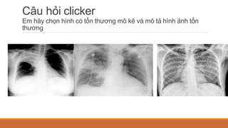Câu hỏi clicker
Em hãy chọn hình có tổn thương mô kẽ và mô tả hình ảnh tổn
thương
 