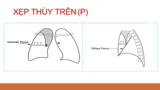 XẸP THÙY TRÊN(P)
 