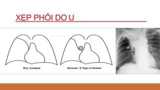 XẸP PHỔI DO U
 