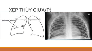 XẸP THÙY GIỮA(P)
 