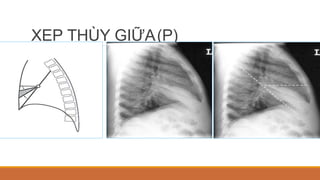 XẸP THÙY GIỮA(P)
 