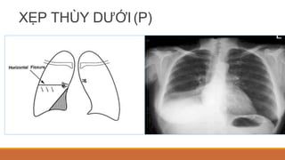 XẸP THÙY DƯỚI(P)
 