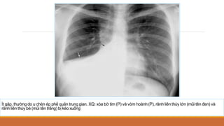 Ít gặp, thường do u chèn ép phế quản trung gian. XQ: xóa bờ tim (P) và vòm hoành (P), rãnh liên thùy lớn (mũi tên đen) và
rãnh liên thùy bé (mũi tên trắng) bị kéo xuống
 