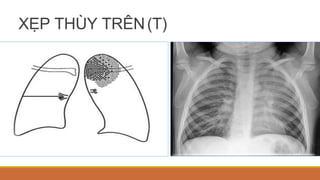 XẸP THÙY TRÊN(T)
 