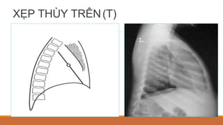 XẸP THÙY TRÊN(T)
 