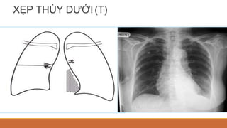 XẸP THÙY DƯỚI(T)
 