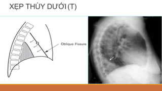 XẸP THÙY DƯỚI(T)
 