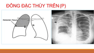 ĐÔNG ĐẶC THÙY TRÊN(P)
 