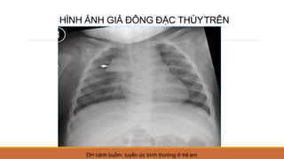 HÌNH ẢNH GIẢ ĐÔNG ĐẶC THÙYTRÊN
DH cánh buồm: tuyến ức bình thường ở trẻ em
 