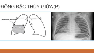 ĐÔNG ĐẶC THÙY GIỮA(P)
 