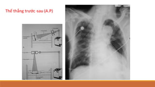 Thế thẳng trước ‐sau (A.P)
 