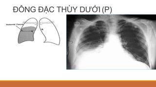 ĐÔNG ĐẶC THÙY DƯỚI (P)
 