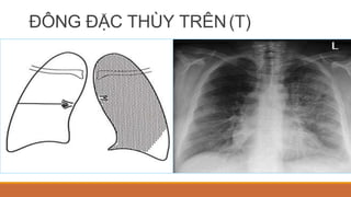 ĐÔNG ĐẶC THÙY TRÊN(T)
 