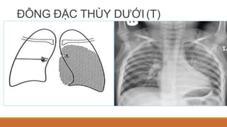 ĐÔNG ĐẶC THÙY DƯỚI (T)
 