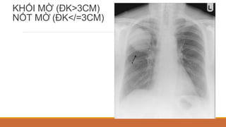 KHỐI MỜ (ĐK>3CM)
NỐT MỜ (ĐK</=3CM)
 