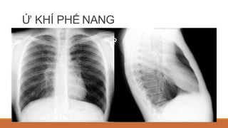 Ứ KHÍ PHẾ NANG
 