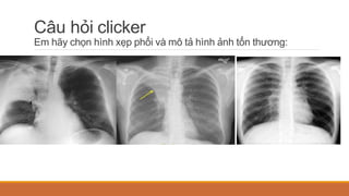 Câu hỏi clicker
Em hãy chọn hình xẹp phổi và mô tả hình ảnh tổn thương:
 