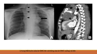 U trung thất trước (xóa bờ ĐMC lên và không xóa bờ ĐMC xuống) và trên
 