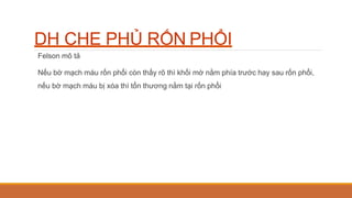 DH CHE PHỦ RỐN PHỔI
Felson mô tả
Nếu bờ mạch máu rốn phổi còn thấy rõ thì khối mờ nằm phía trước hay sau rốn phổi,
nếu bờ mạch máu bị xóa thì tổn thương nằm tại rốn phổi
 