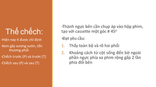 -
‐Thành ngực bên cần chụp áp vào hộp phim,
tạo với cassette một góc # 450
-
‐Đạt yêu cầu:
1. Thấy toàn bộ và rõ hai phổi
2. Khoảng cách từ cột sống đến bờ ngoài
phần ngực phía xa phim rộng gấp 2 lần
phía đối bên
Thế chếch:
-
‐Hiện nay ít được chỉ định
-
‐Xem gãy xương sườn, tổn
thương phổi
-
‐Chếch trước (P) và trước (T)
-
‐Chếch sau (P) và sau (T)
 