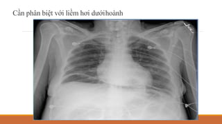 Cần phân biệt với liềm hơi dướihoành
 