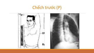 Chếch trước (P)
 