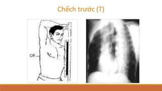 Chếch trước (T)
 