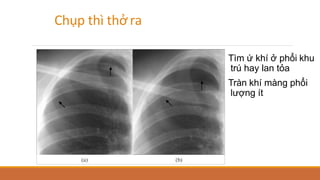 Chụp thì thở ra
Tìm ứ khí ở phổi khu
trú hay lan tỏa
Tràn khí màng phổi
lượng ít
 