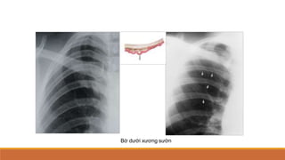 Bờ dưới xương sườn
 