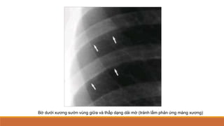 Bờ dưới xương sườn vùng giữa và thấp dạng dải mờ (tránh lầm phản ứng màng xương)
 