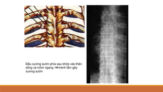Đầu xương sườn phía sau khớp vào thân
sống và mỏm ngang 
tránh lầm gãy
xương sườn
 