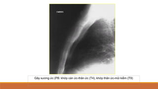 Gãy xương ức (PB: khớp cán ức-thân ức (T4), khớp thân ức-mũi kiếm (T9)
 