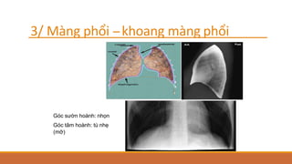 3/ Màng phổi -‐khoang màng phổi
Góc sườn hoành: nhọn
Góc tâm hoành: tù nhẹ
(mỡ)
 