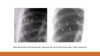 Rãnh liên thùy bé: hơi lồi về phía trên, ngoài cao nhẹ, dài 2/3 phế trường, dạng 1 hoặc 2 đường mờ
 