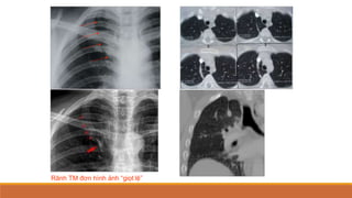 Rãnh TM đơn hình ảnh “giọt lệ”
 