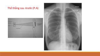 Thế thẳng sau -
‐trước (P.A)
 