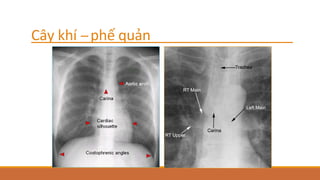 Cây khí -‐phế quản
 